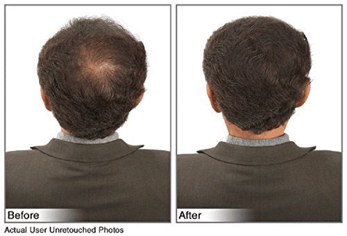 Hair Building Fibers Instantly Conceal Thinning Hair and Bald Spots for Men & Women (Large 28 Grams Bottle) - Undetectable, Washes Away, For All Hair Types, No Animal Byproducts (Dark Brown)
