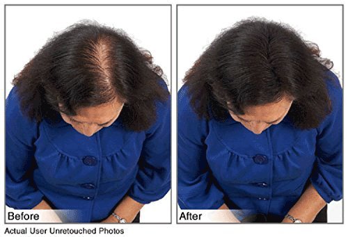 Hair Building Fibers Instantly Conceal Thinning Hair and Bald Spots for Men & Women (Large 28 Grams Bottle) - Undetectable, Washes Away, For All Hair Types, No Animal Byproducts (Dark Brown)