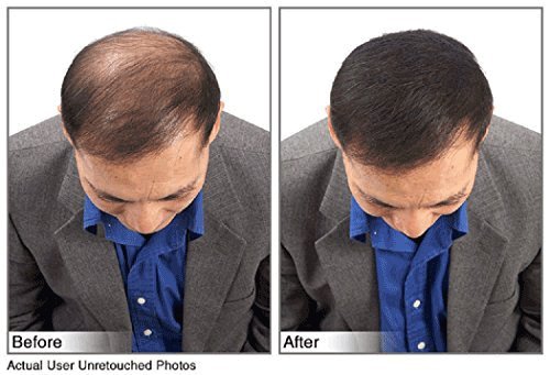 Hair Building Fibers Instantly Conceal Thinning Hair and Bald Spots for Men & Women (Large 28 Grams Bottle) - Undetectable, Washes Away, For All Hair Types, No Animal Byproducts (Dark Brown)