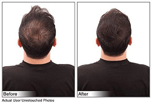 Hair Building Fibers Instantly Conceal Thinning Hair and Bald Spots for Men & Women (Large 28 Grams Bottle) - Undetectable, Washes Away, For All Hair Types, No Animal Byproducts (Dark Brown)
