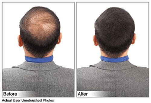 Hair Building Fibers Instantly Conceal Thinning Hair and Bald Spots for Men & Women (Large 28 Grams Bottle) - Undetectable, Washes Away, For All Hair Types, No Animal Byproducts (Dark Brown)