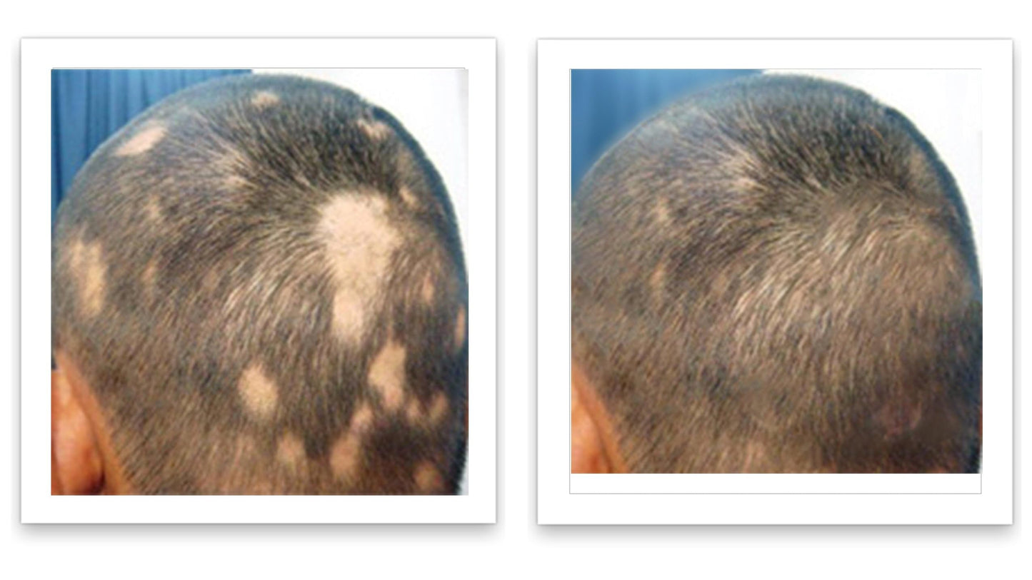 Caboki 10X Hair Powder for Thinning Hair. Instantly Fill In Hairline, Root Touch Up, Cover Bald Spots and Gray Hair. TALC-Free, Healthful Formula. Unisex. Trial Size, Salt and Pepper Dark