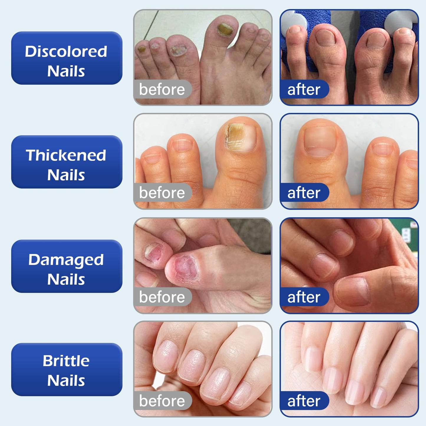 Multi-Purpose Nail Repair, Nail Solution with Tea Tree Oil for Discolored and Damaged Nails，Plant Drops for Nails Care，Discolored and Damaged Nails (1PC) ﻿