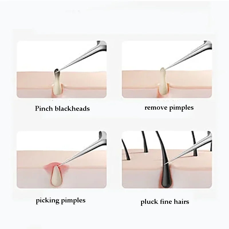 Ingrown Hair and Blackhead Tools