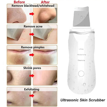 Ultrasonic Blackhead Remover Facial Cleaner